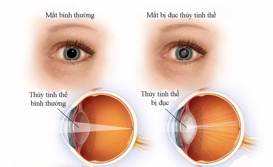 Cườm khô người già - Hình ảnh minh họa
